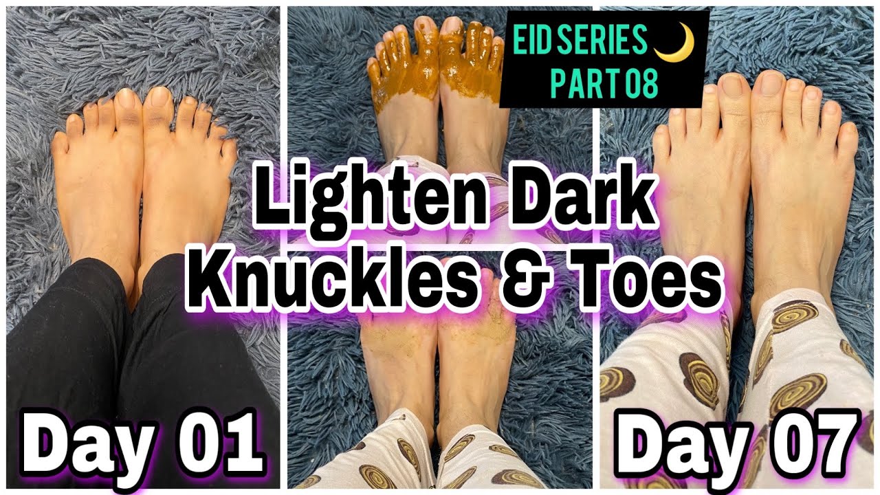 Dark Elbow, Knee And Knuckle Whitening Serum In Waterloo In Nebraska, United States Call ☏ +2771 073 2372 Get Rid Of Tattoos And Dark Spots In Kärsta Municipality in Sweden